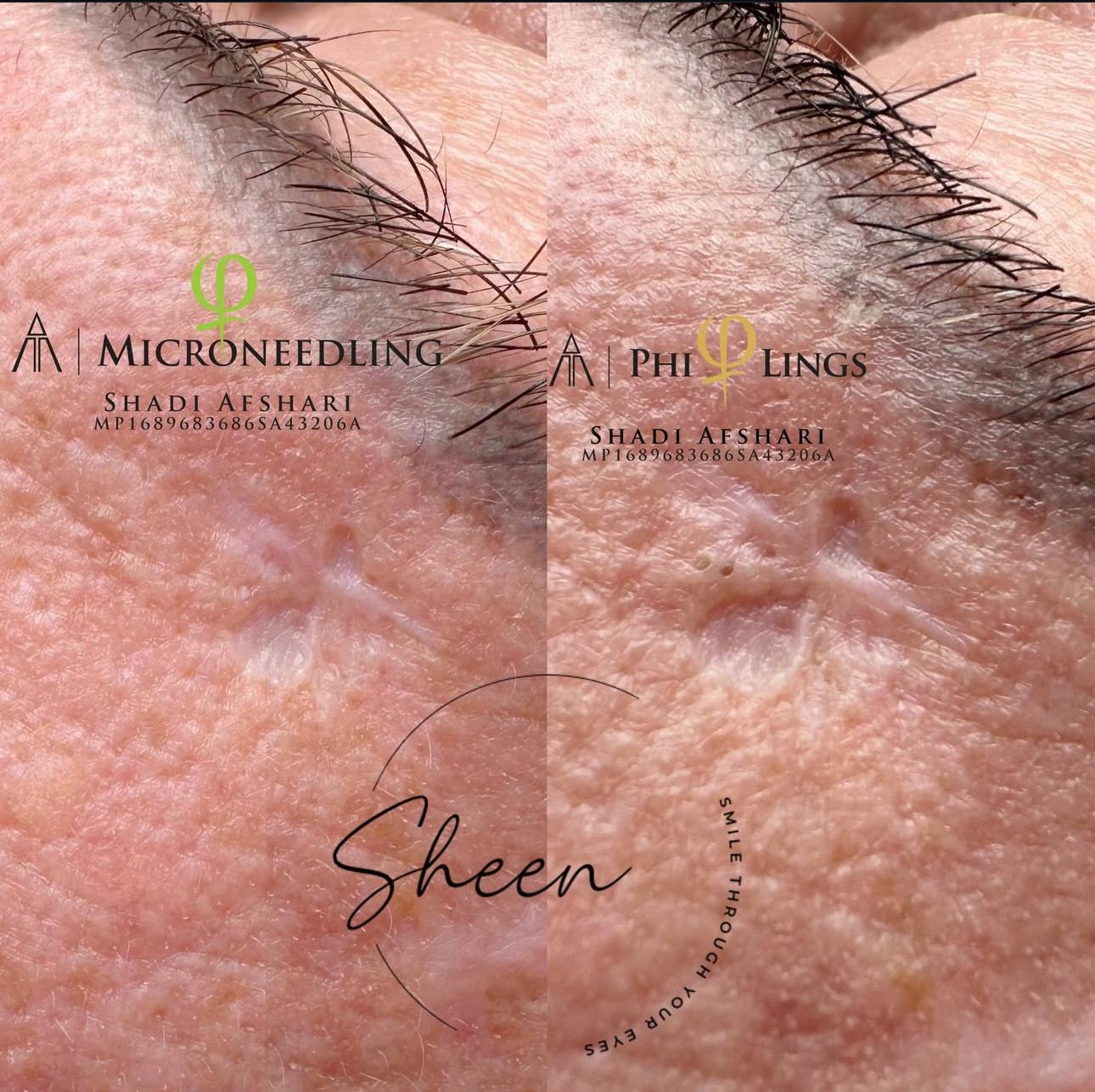 Microneedling